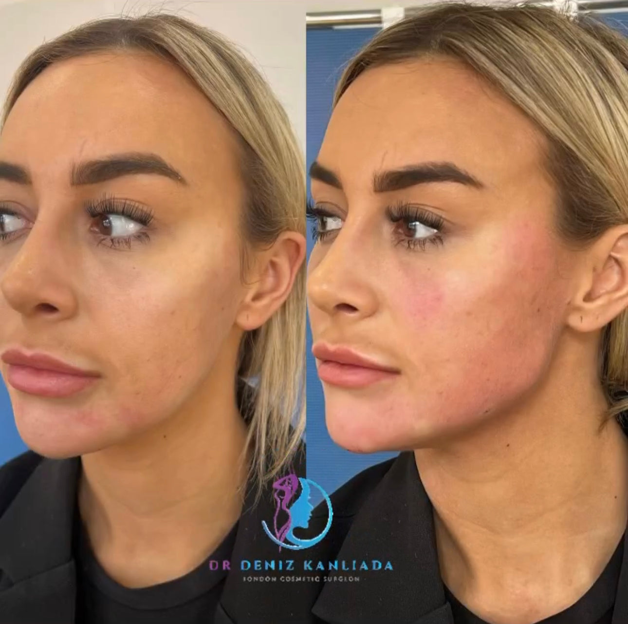 Foundation filler and botulinum toxin