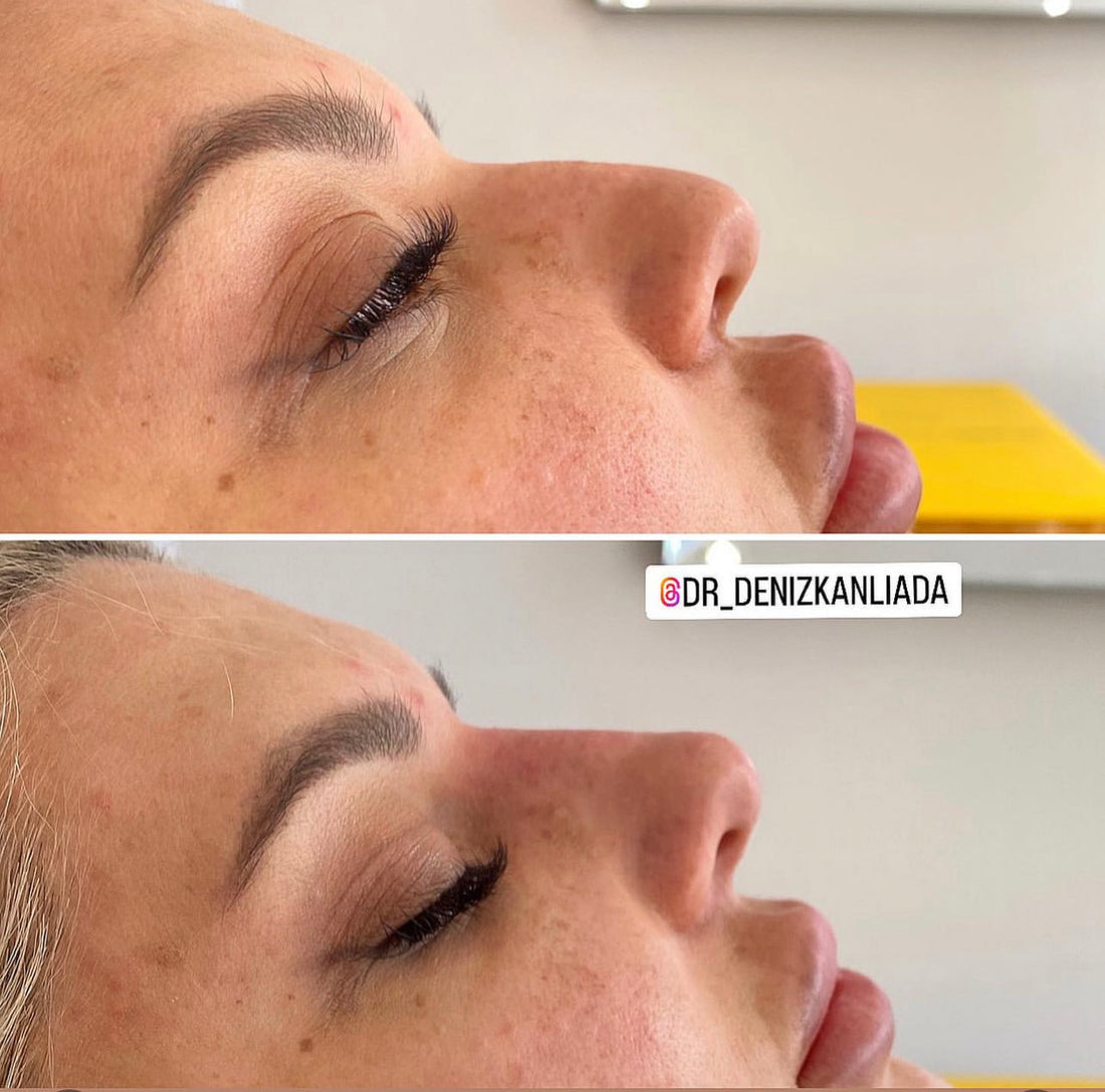 Master class non-surgical rhinoplasty with the nose king